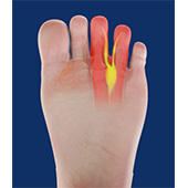 Morton's Neuroma