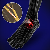Nerve Conditions of the Foot