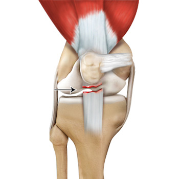 Patellar Tendon Rupture