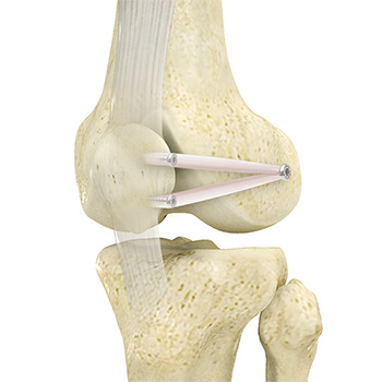Patellofemoral Stabilization