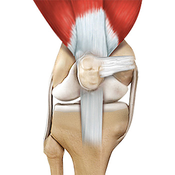 Quadriceps Tendon Repair
