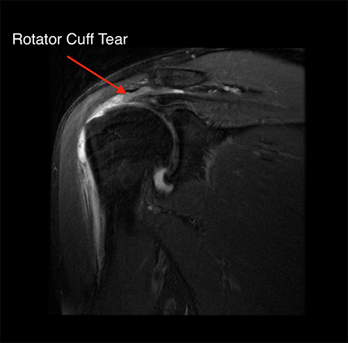 Rotator Cuff Tear