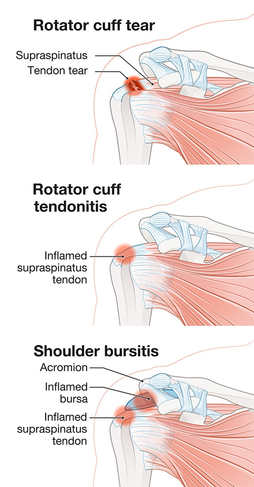 Rotator Cuff Tear