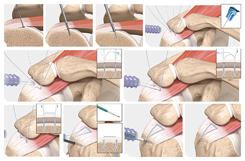 Rotator Cuff Tear