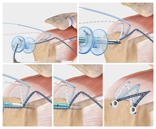Rotator Cuff Tear