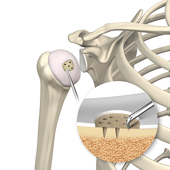 Shoulder Preservation Surgery