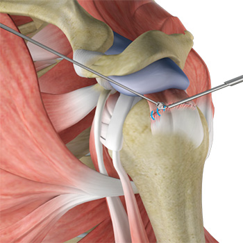 Shoulder Stabilization