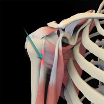 Shoulder Tendonitis