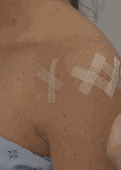 Rotator Cuff Tear