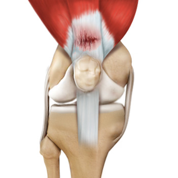 Tendon Injuries