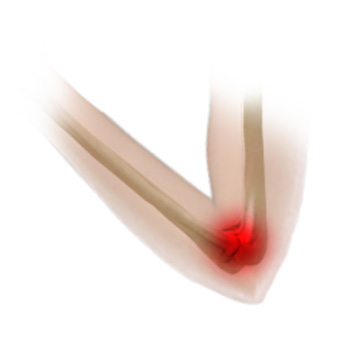 UCL Reconstruction (Tommy John Surgery)
