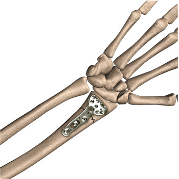 Wrist Open Reduction and Internal Fixation