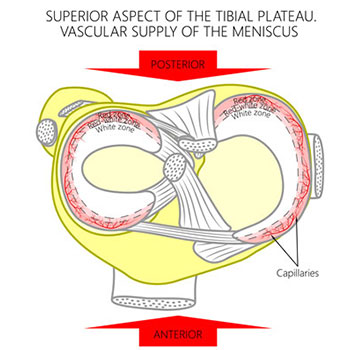 Meniscal Tears
