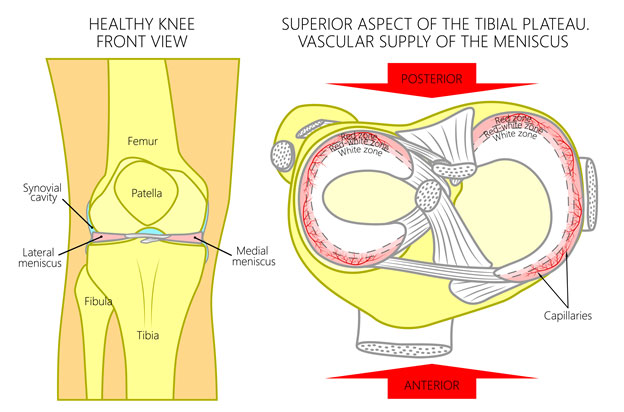 Meniscal Tears