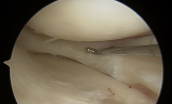 Meniscal Tears