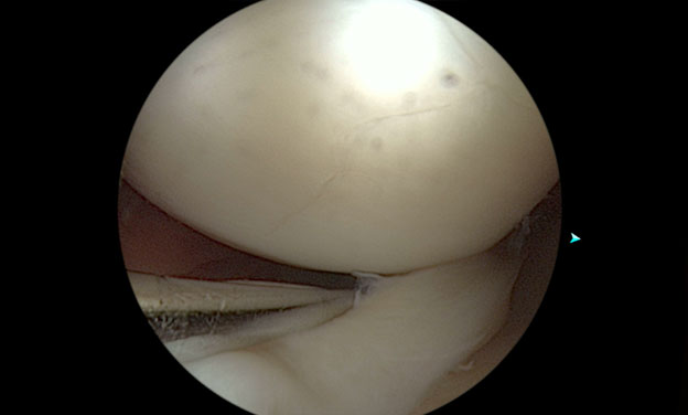Meniscal Tears