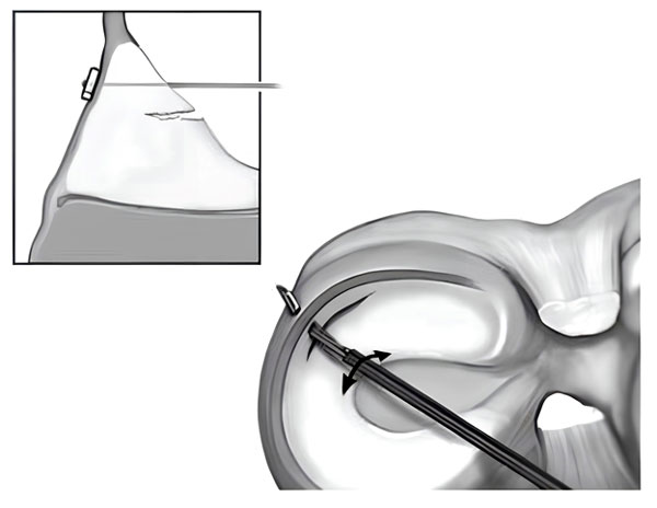 Meniscal Tears