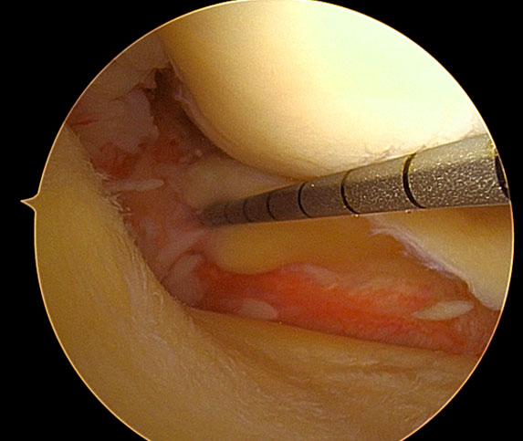 Meniscal Tears