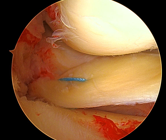 Meniscal Tears