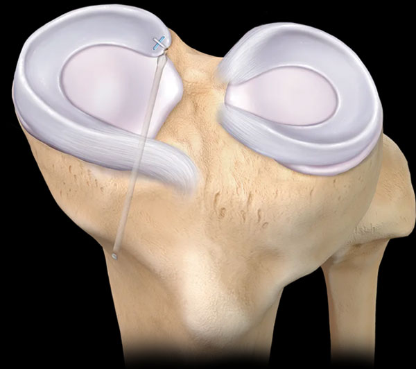 Meniscal Tears