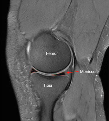 Meniscal Tears