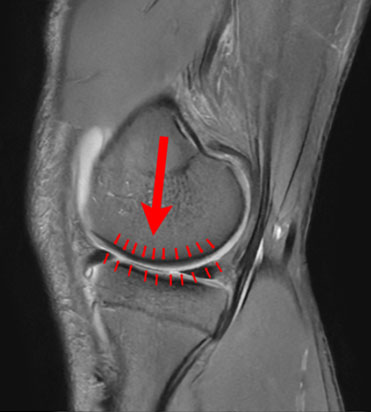 Meniscal Tears