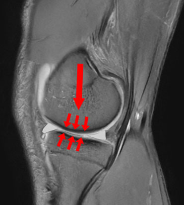 Meniscal Tears