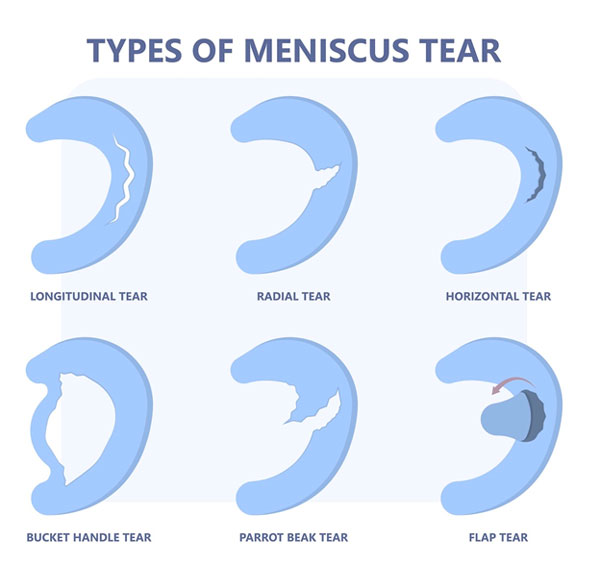 Meniscal Tears