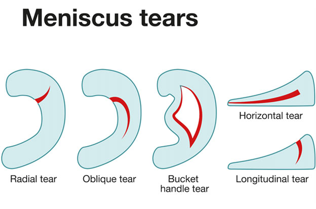 Meniscal Tears