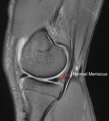 Meniscal Tears
