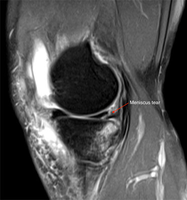 Meniscal Tears