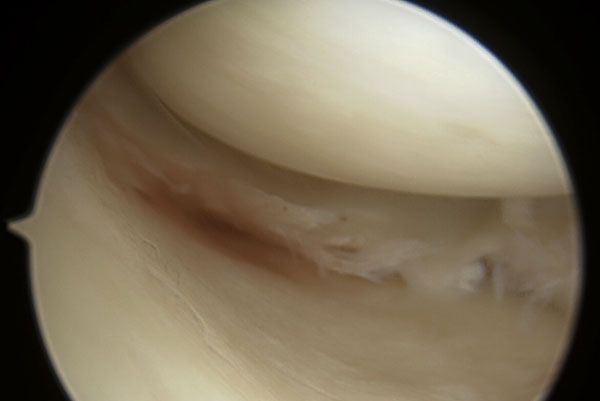 Meniscal Tears