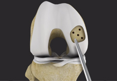 Cartilage Preservation Techniques