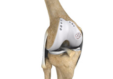Cartilage Transplantation