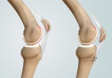 Distal Realignment Procedures