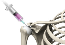 Intra-Articular Joint Injections