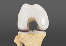 Joint Preservation Surgery