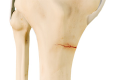 Knee Stress Fractures
