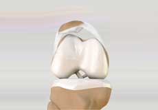 Lateral Patellar Instability