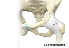 Ligament Preservation/Repair