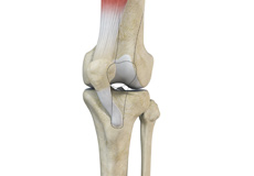 Medial Patellar Instability