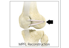 Medial Patellofemoral Ligament  Reconstruction