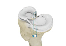 Meniscus Root Tear