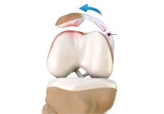 Medial Patellofemoral Ligament (MPFL) Tears