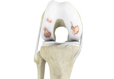 Osteoarthritis
