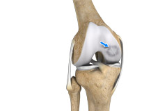 Osteochondral Defect of the Knee