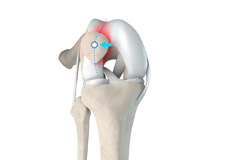 Patellar Tracking Disorder/Patellar Maltracking