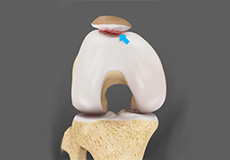 Patellofemoral Arthritis