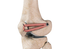 Patellofemoral Knee Replacement