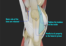 Patellofemoral Realignment